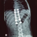 How much is a lumbar fusion worth?