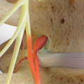 Is a herniated disc a serious problem?