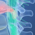 Is a bulging disc a serious injury?