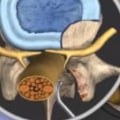 Do herniated discs ever go away?
