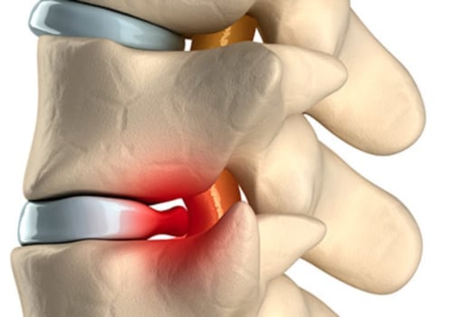 Is a herniated disk a big deal?