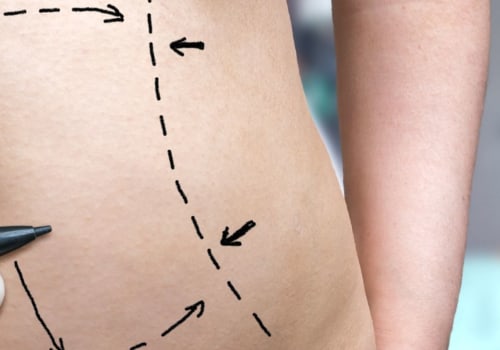 How much is a pinched nerve worth?